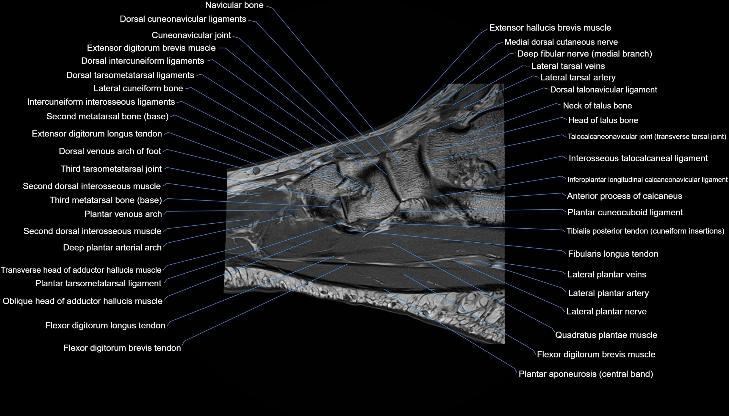 MRI mid foot sagittal cross sectional anatomy 3T  radiology  image-img-00001-00022.webp